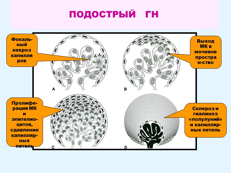 ПОДОСТРЫЙ   ГН Фокаль- ный некроз   капилляров Выход МК в мочевое